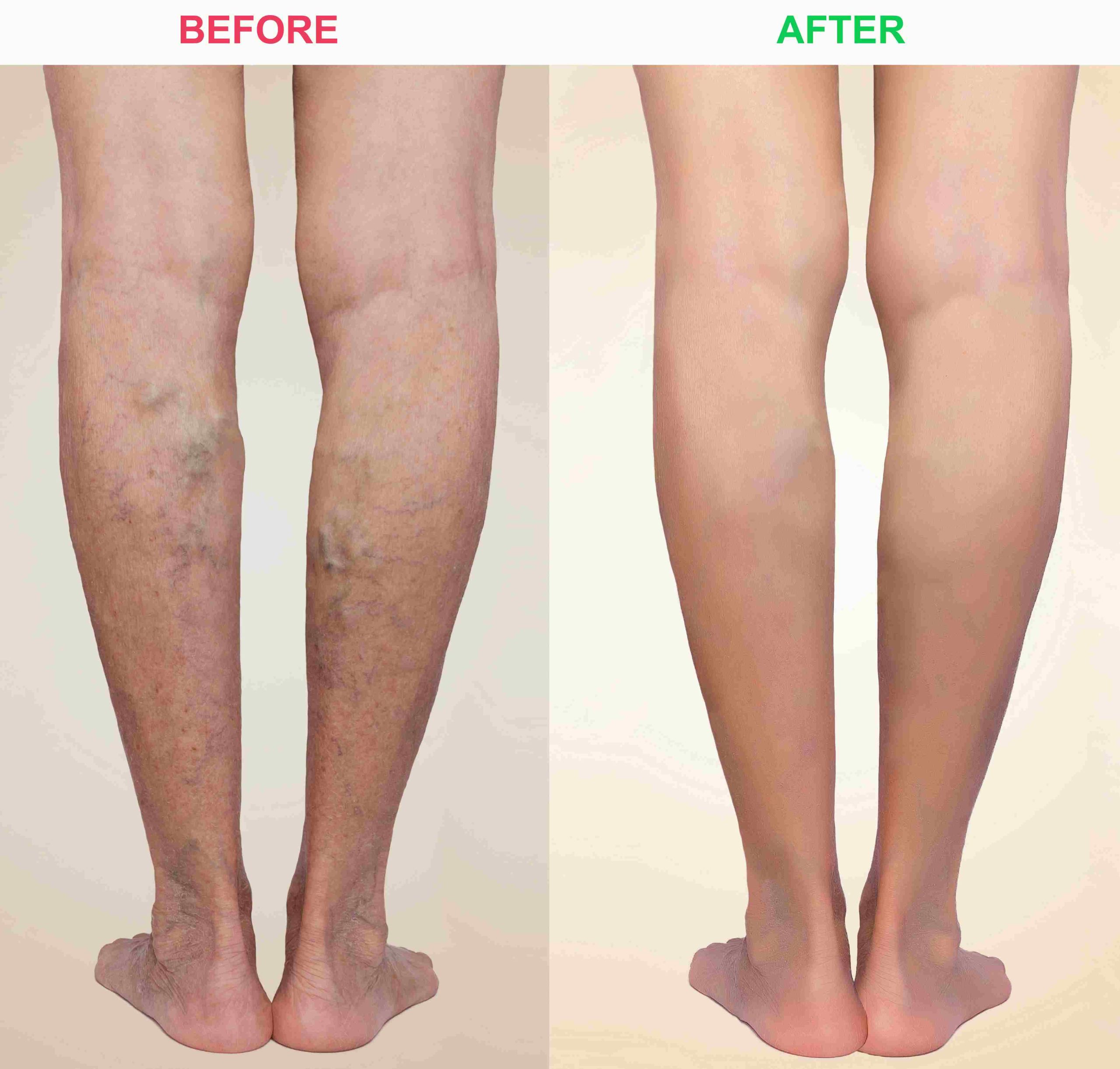 Before and After Laer Vein Removal treatment | Avail Aesthetics in Cary, Raleigh & Wake Forest, NC