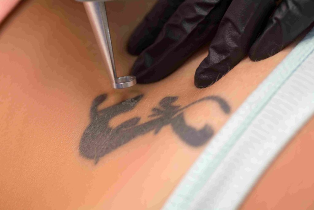 Tattoo Removal  The Laser Lounge Spa