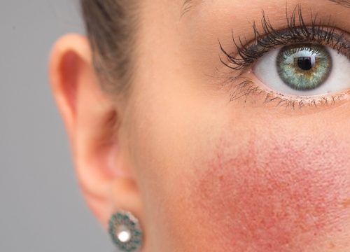 Red flushing cheeks are seen closeup, in the face of a stunning thirty something caucasian girl, permanent redness and small visible blood vessels, symptoms of Rosacea | Avail Aesthetics in Cary, Raleigh & Wake Forest, NC