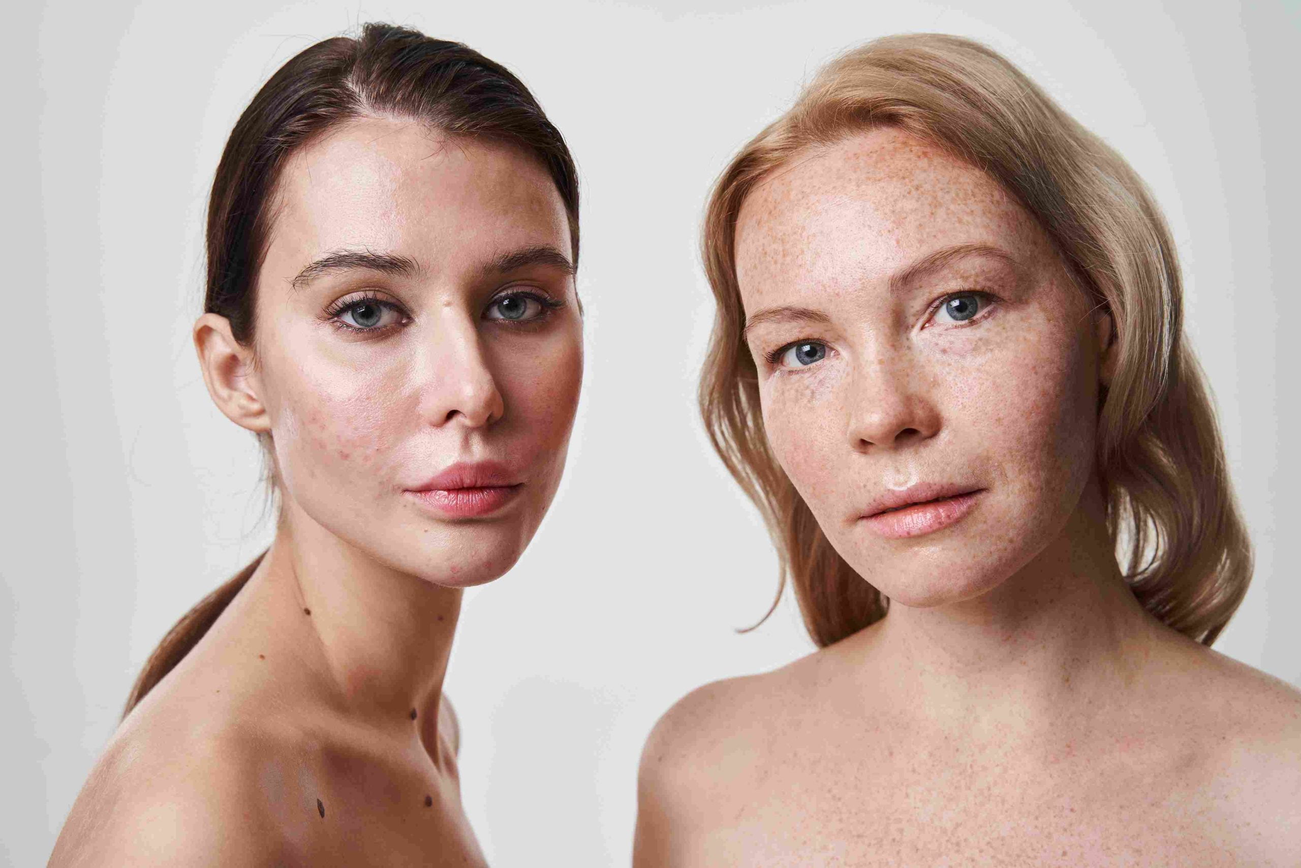 Two ladies face filled with acne | Subnovii | Avail Aesthetics in Cary, Raleigh & Wake Forest, NC