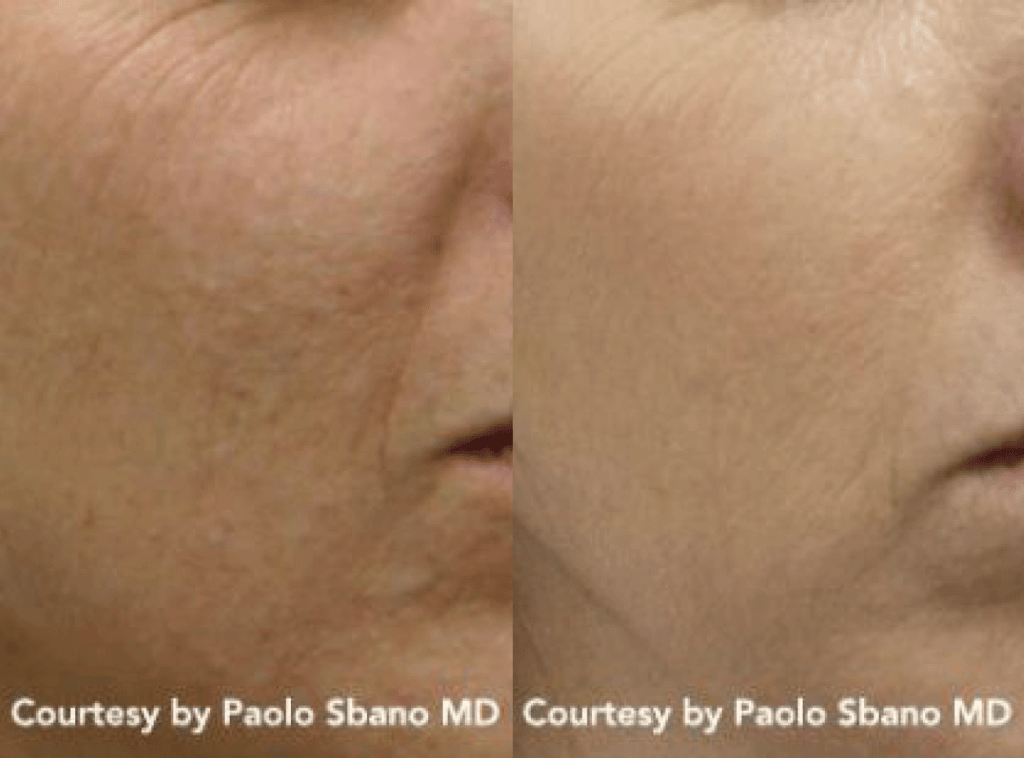 Young Girl Before & After Discovery Pico Treatment | Avail Aesthetics in Wake Forest, NC