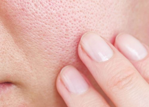 Close up of Enlarged Pores | Avail Aesthetics in Cary, NC