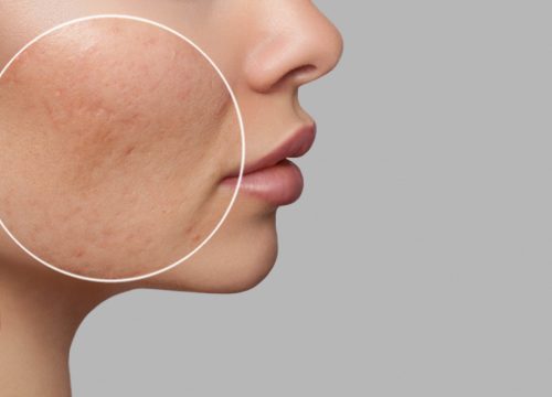 Female Clear Skin Vs Acne Scars | Avail Aesthetics in Raleigh, NC