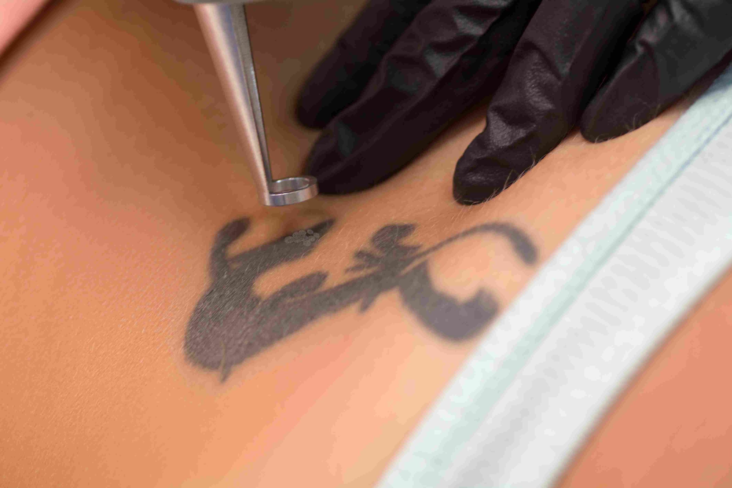 Aesthetician Removing Tattoo with Picosure Laser | Avail Aesthetics in Cary, NC