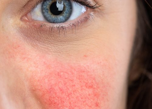 Redness-Vessels on woman cheeks | Avail Aesthetics in Cary, NC
