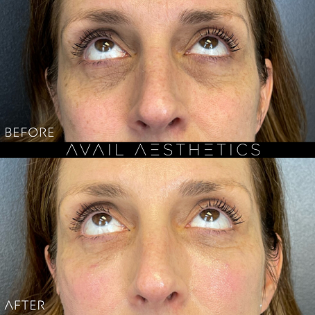 PRP Bio-Gel Filler Before & After Treatment Photos in North Carolina | Avail Aesthetics