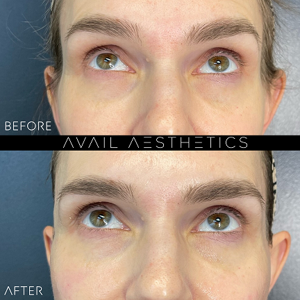 PRP Bio-Gel Filler Before & After Treatment Photos in North Carolina | Avail Aesthetics