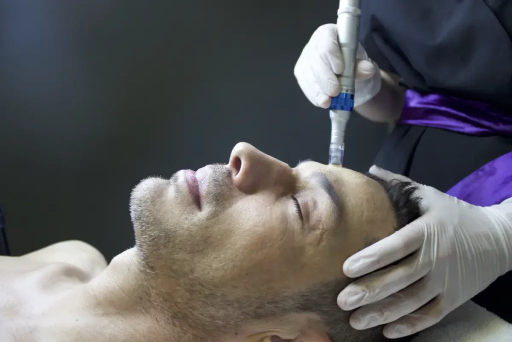 Collagen Induction Therapy at Avail Aesthetics in CARY, NC