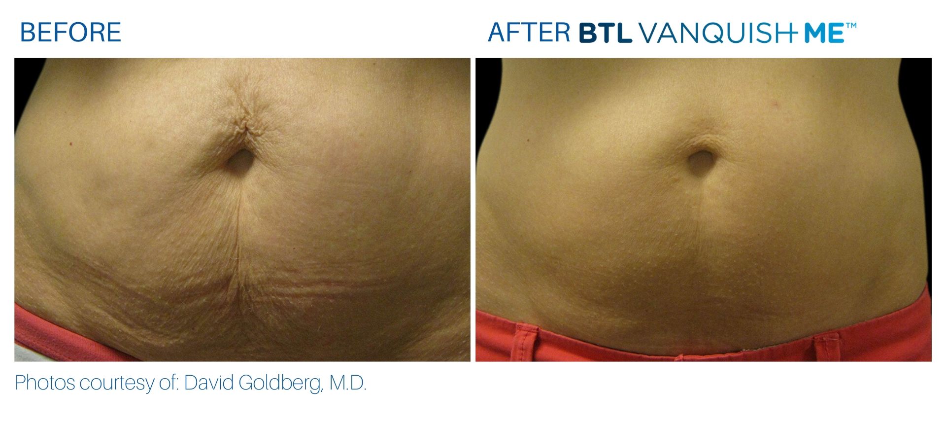 Before & After Vanquish Me Fat Reduction treatment results | Avail Aesthetics in Cary, Raleigh & Wake Forest, NC