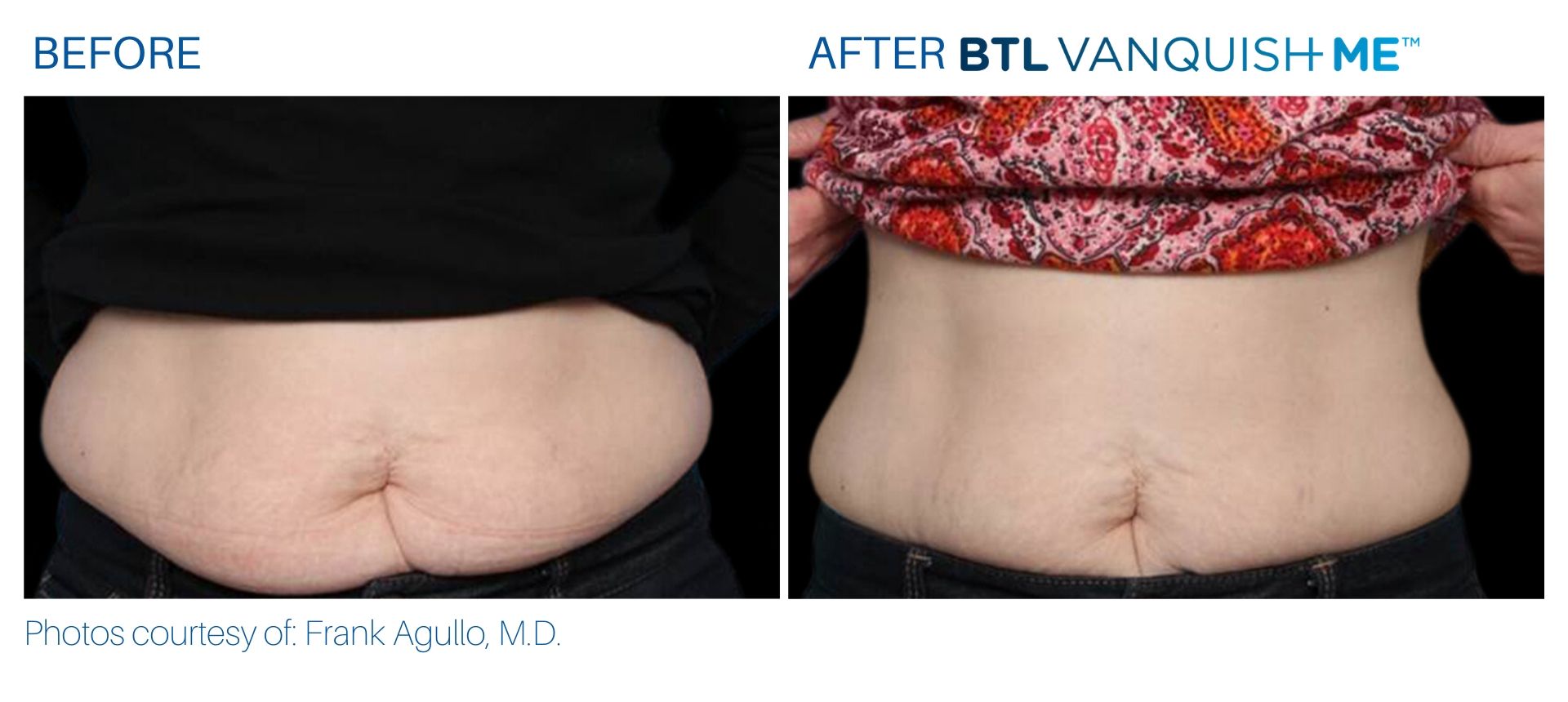 Before & After Vanquish Me Fat Reduction treatment results | Avail Aesthetics in Cary, Raleigh & Wake Forest, NC