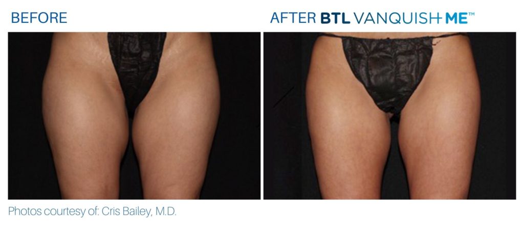 Before & After Vanquish Me Fat Reduction treatment results | Avail Aesthetics in Cary, Raleigh & Wake Forest, NC