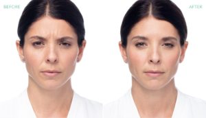 Female Facial Rejuvenation | Before and After Dysport® | wrinkle filler | Face | | Avail Aesthetics in Cary, Raleigh & Wake Forest, NC