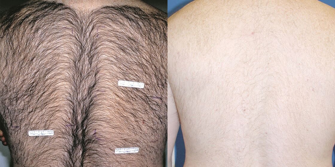 Before & After ICON Treatment Image | Avail Aesthetics in NC