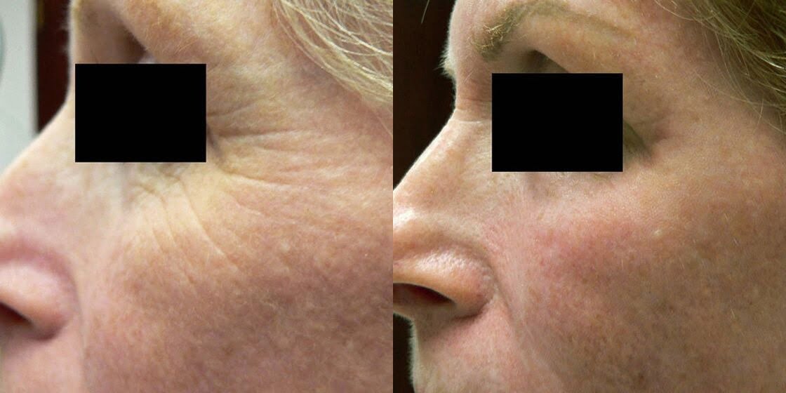 Before & After ICON Treatment Image | Avail Aesthetics in NC