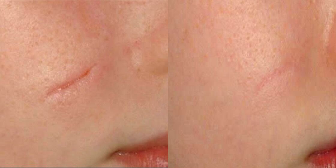 Before & After ICON Treatment Image | Avail Aesthetics in NC