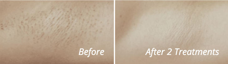 Before & After Motus AZ+ Treatment Image | Avail Aesthetics in NC