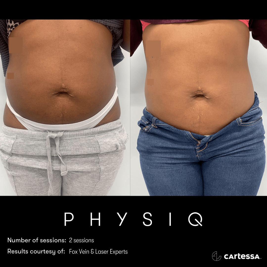 Before & After Image of PHYSIQ Body Contouring | Avail Aesthetics in Wake Forest, NC