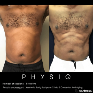 Before & After Image of PHYSIQ Body Contouring | Avail Aesthetics in Wake Forest, NC