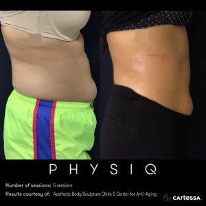 PHYSIQ Body Contouring Before & After Image | Avail Aesthetics in NC