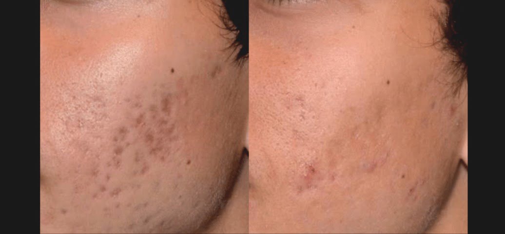 Before & After PicoSure Skin Revitalization Treatment Image | Avail Aesthetics in NC