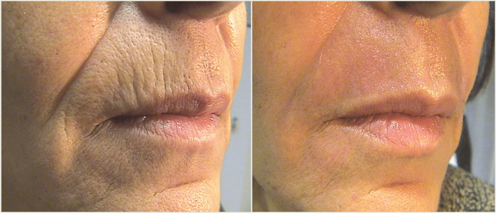 Tetra-BA-Lip-lines-courtesy-of-Giovanni-Cannarozzo-MD