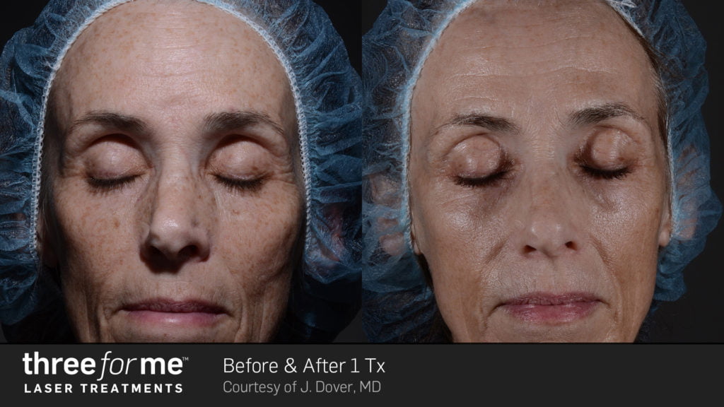 Before & After Image of ThreeforMe Treatment | Avail Aesthetics in Wake Forest, NC