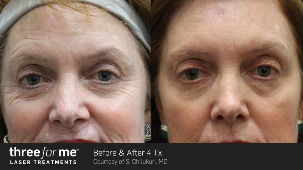 Before & After Image of ThreeforMe Treatment | Avail Aesthetics in Wake Forest, NC