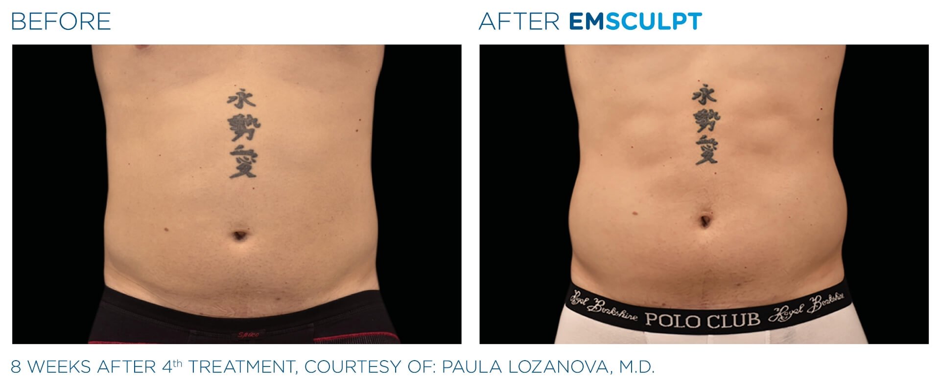 Before & After Image of Emsculpt Body Sculpting Treatment | Avail Aesthetics in Wake Forest, NC