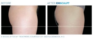 Before & After Image of Emsculpt Body Sculpting Treatment | Avail Aesthetics in Wake Forest, NC