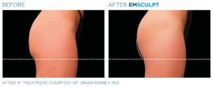 Before & After Image of Emsculpt Body Sculpting Treatment | Avail Aesthetics in Wake Forest, NC