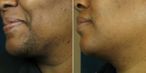 Before & After Image of Laser Hair Removal Treatment | Avail Aesthetics in Wake Forest, NC