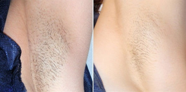 Before & After Image of Laser Hair Removal Treatment | Avail Aesthetics in Wake Forest, NC