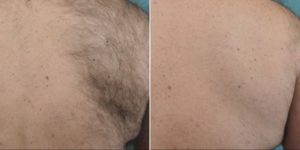 Before & After Image of Laser Hair Removal Treatment | Avail Aesthetics in Wake Forest, NC