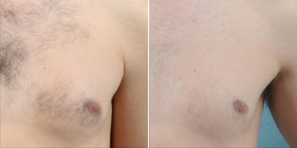 Before & After Image of Laser Hair Removal Treatment | Avail Aesthetics in Wake Forest, NC