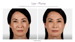 Before and After Juvederm Treatment result of Female - Lip Plump | Avail Aesthetics in Cary, Raleigh & Wake Forest, NC