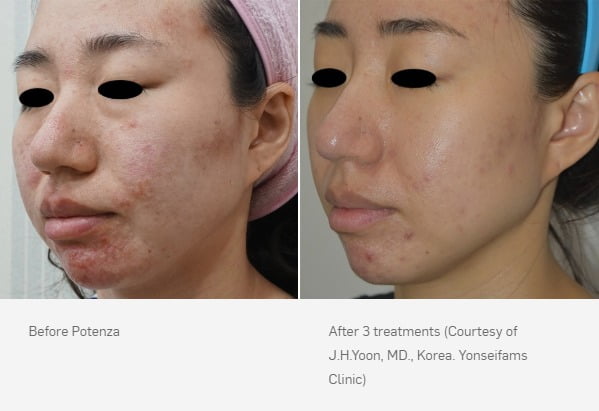 Before & After Potenza™ RF Microneedling Treatment Image | Avail Aesthetics in NC