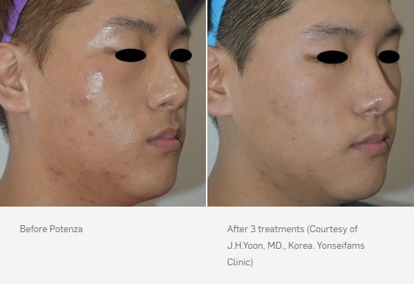 Before & After Potenza™ RF Microneedling Treatment Image | Avail Aesthetics in NC