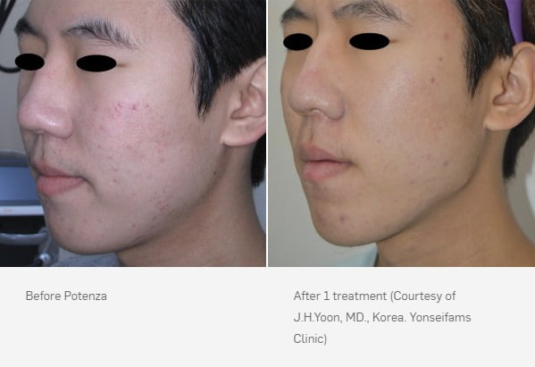 Before & After Potenza™ RF Microneedling Treatment Image | Avail Aesthetics in NC