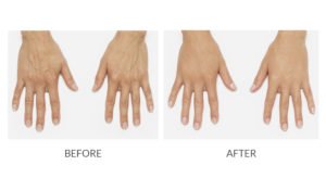 Hand Rejuvenation | Before and After RADIESSE | wrinkle filler | Hand | | Avail Aesthetics in Cary, Raleigh & Wake Forest, NC