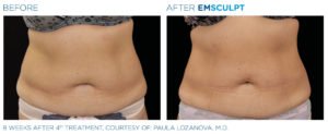 Before & After Image of Emsculpt Body Sculpting Treatment | Avail Aesthetics in Wake Forest, NC