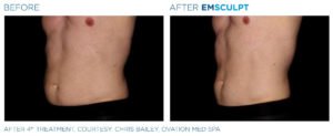 Before & After Image of Emsculpt Body Sculpting Treatment | Avail Aesthetics in Wake Forest, NC