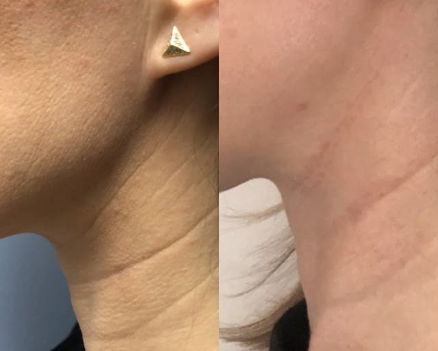 subnovii Treatment Woman Before & After Image | Avail Aesthetics in Wake Forest, NC