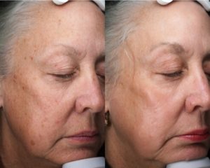 subnovii Treatment Woman Before & After Image | Avail Aesthetics in Wake Forest, NC