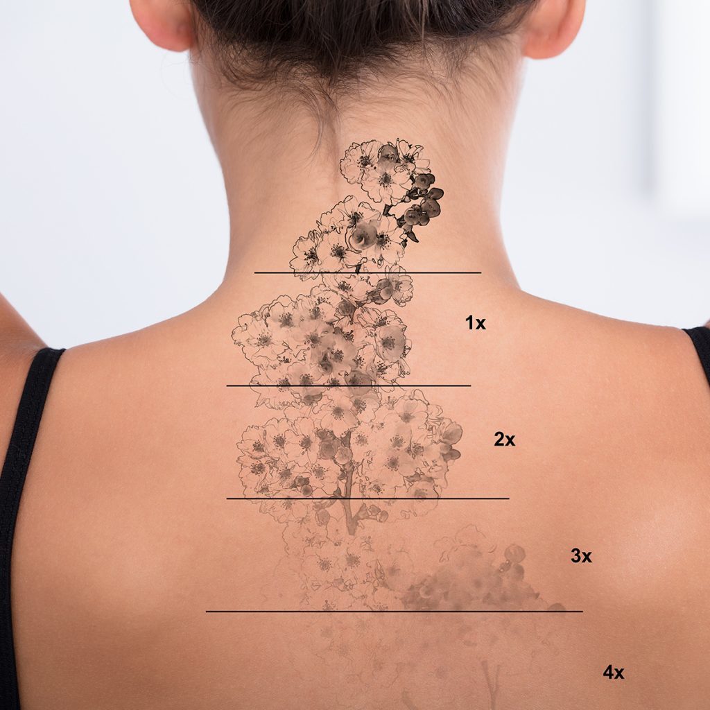 Unwanted Tattoo on woman back | Avail Aesthetics in Cary, NC