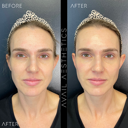 PRP Bio-Gel Filler Before & After Treatment Photos in North Carolina | Avail Aesthetics