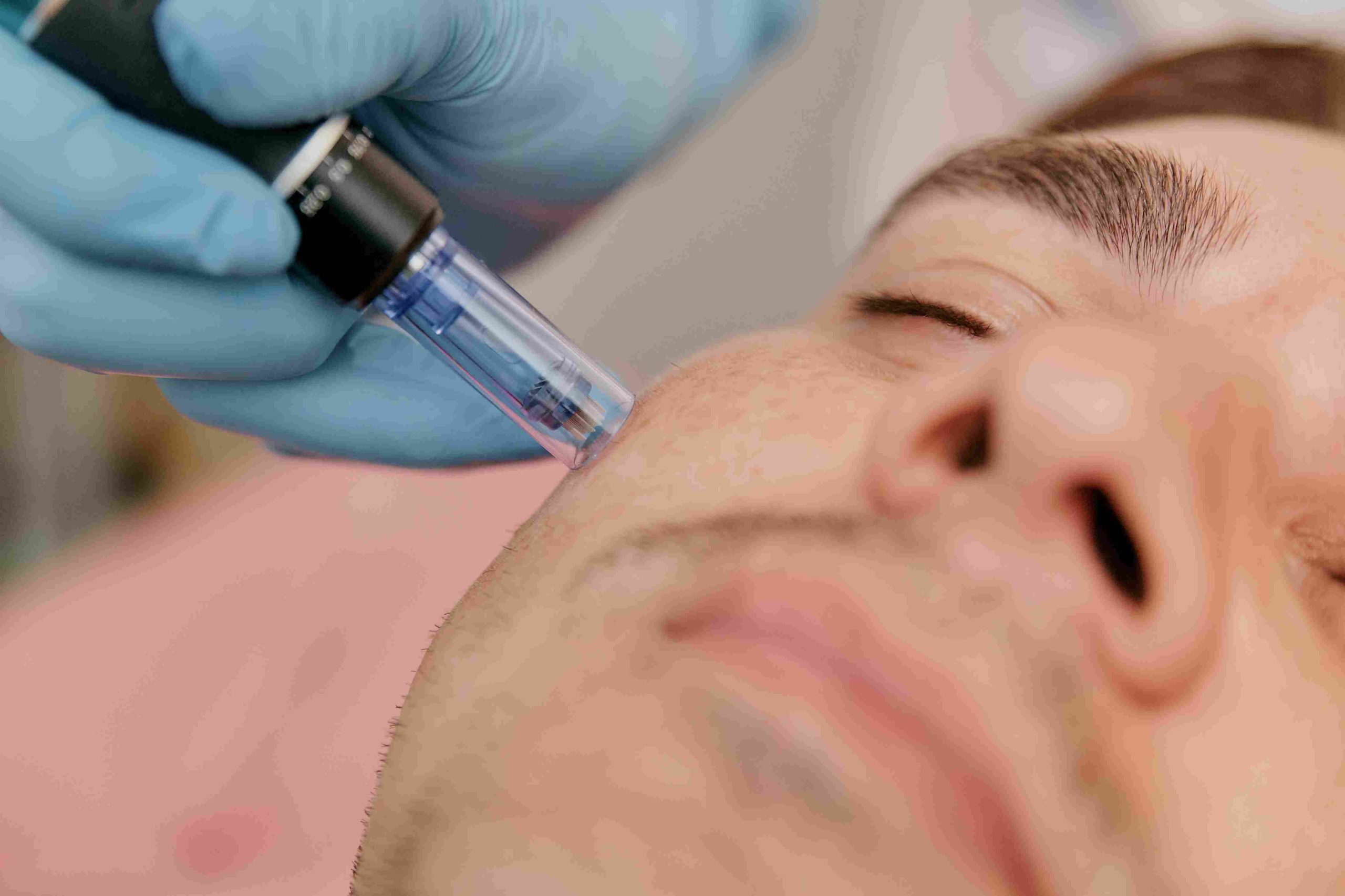 Handsome European Man Getting Collagen Induction Therapy Microneedling on the Face | Avail Aesthetics in Wake Forest, NC