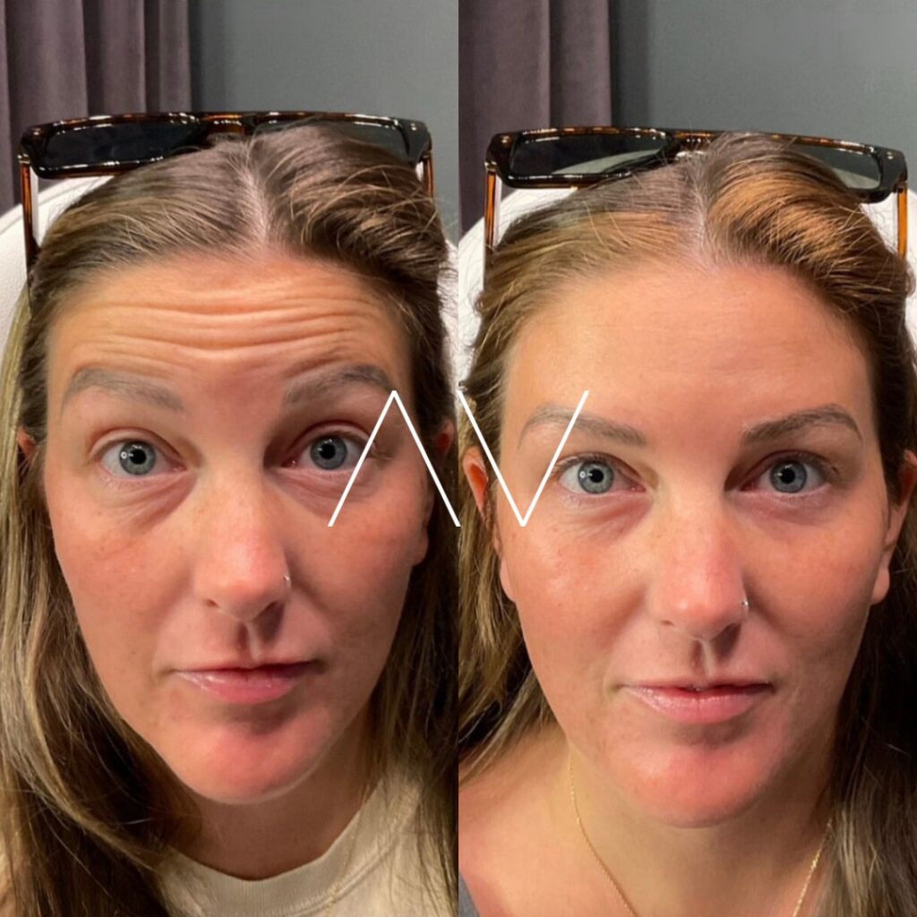 Before-and-After-Dysport