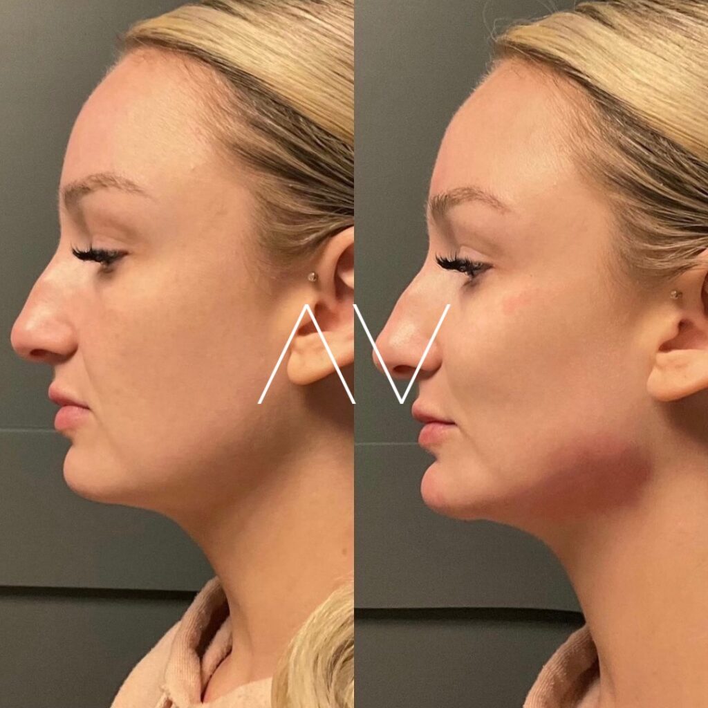 Radiesse-before-and-after