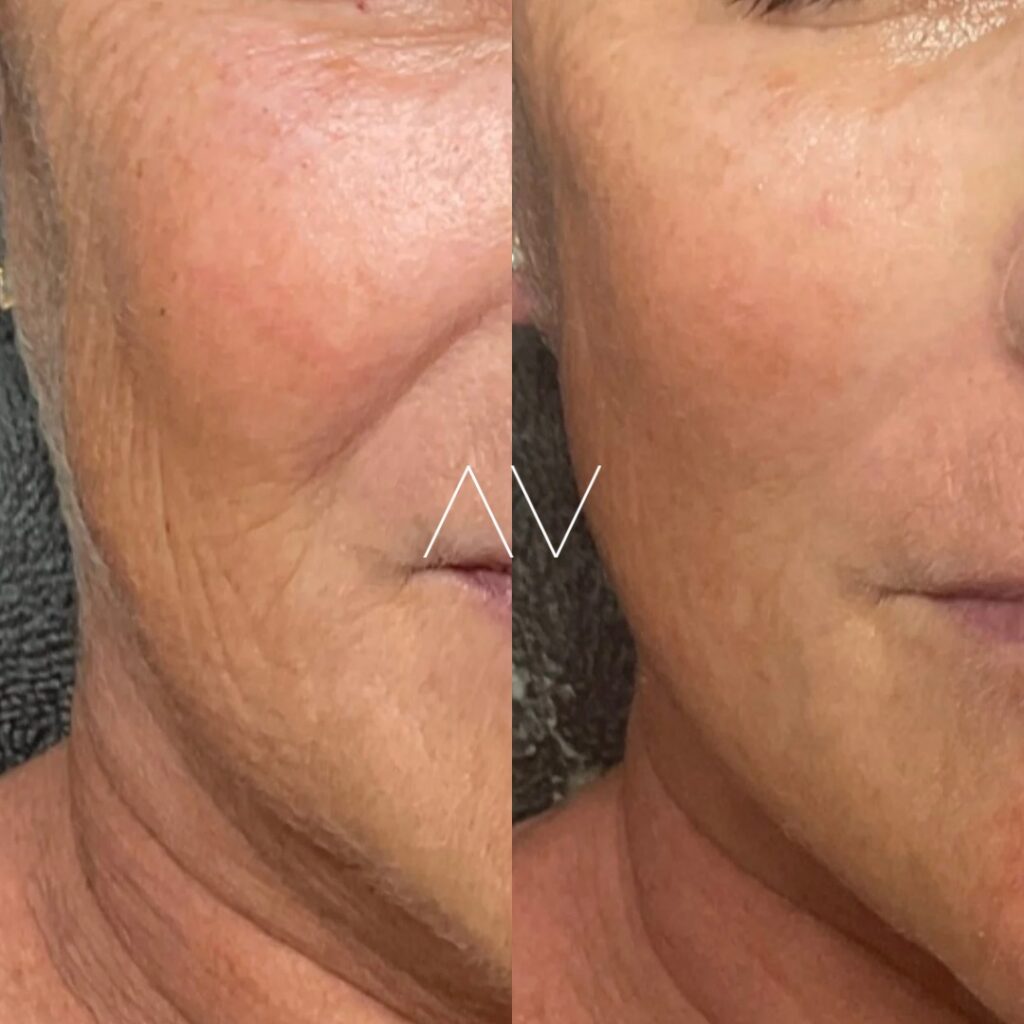 DMK-BeforeAfter
