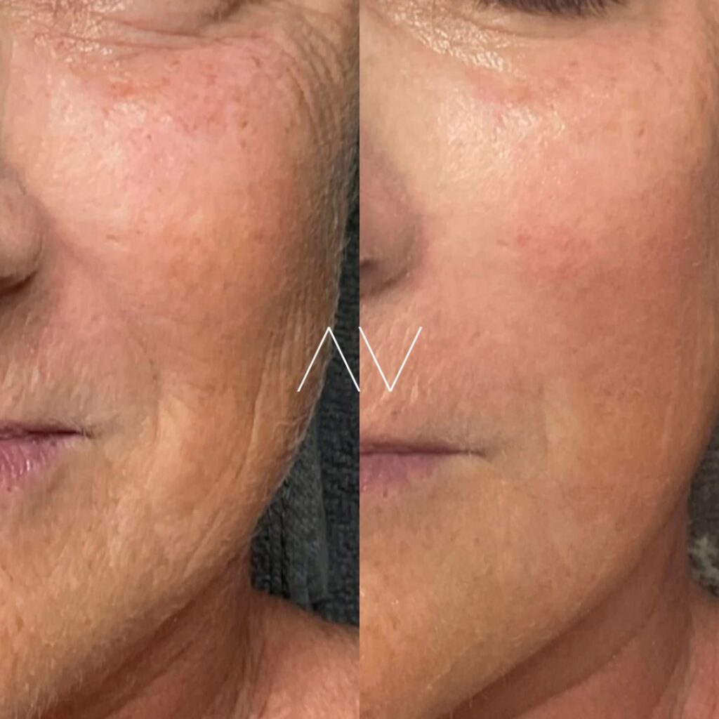 DMK-BeforeAfter